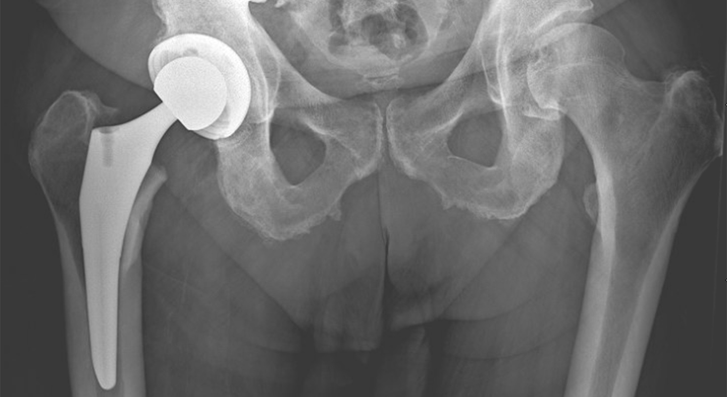 Total Hip Arthroplasty Cu Sports Med Hip Clinic