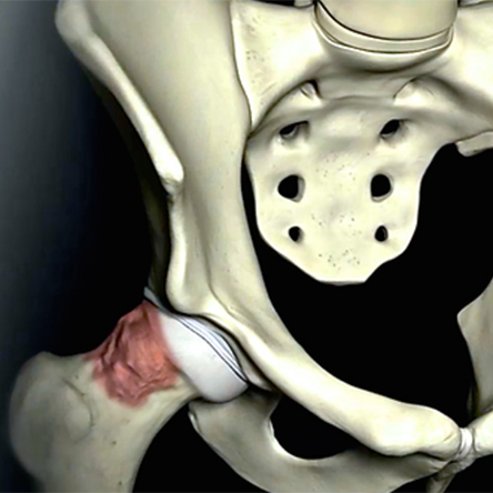 Ask Dr. Gibbs: Do I have hip impingement? - Heiden Orthopedics
