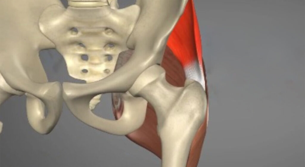 Hip Abductor Injury CU Sports Med Hip Clinic